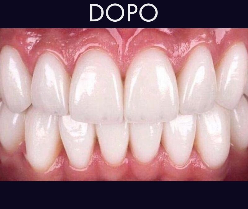 Le faccette dentali in ceramica regalano un sorriso libero da imperfezioni