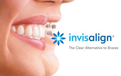 Ortodonzia, con Invisalign sorridere non sarà più un problema