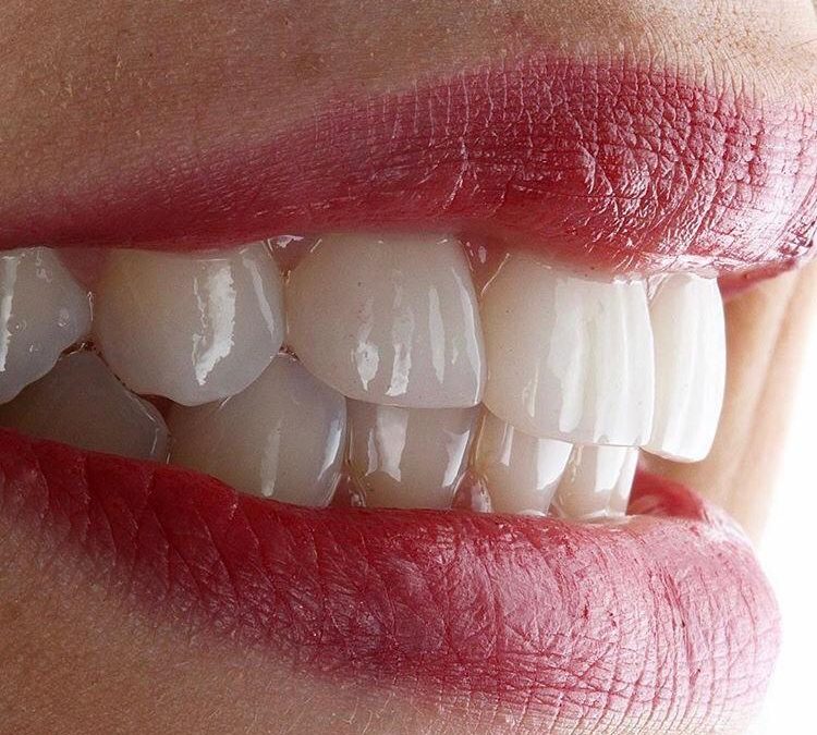 Impianti, come avere un sorriso perfetto e funzionale